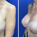 Implant Exchange with Breast Lift Before & After Patient #2827