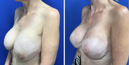 Implant Exchange with Breast Lift Before & After Patient #2827