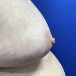 Inverted Nipple Correction with Galaflex Before & After Patient #2875