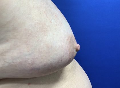 Inverted Nipple Correction with Galaflex Before & After Patient #2875