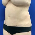 Liposuction Before & After Patient #2888