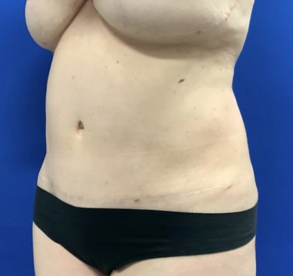 Liposuction Before & After Patient #2888