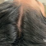 PRP For Hair Restoration Before & After Patient #2902