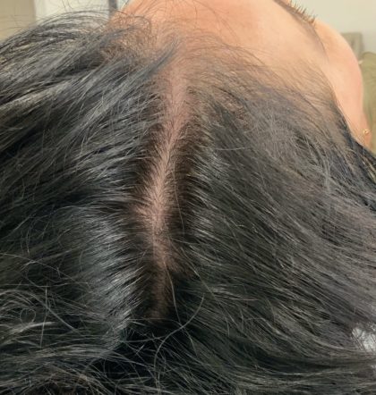 PRP For Hair Restoration Before & After Patient #2902