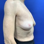 Implant Removal with Capsulectomy Before & After Patient #2910