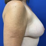 Implant Removal with Capsulectomy Before & After Patient #2913