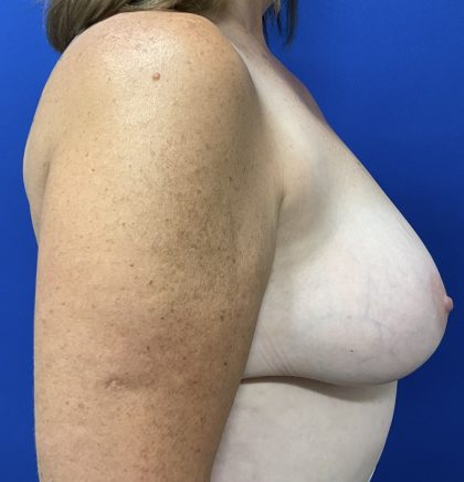 Implant Removal with Capsulectomy Before & After Patient #2913