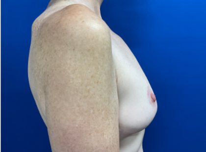 Breast Reduction With Galaflex Before & After Patient #2733