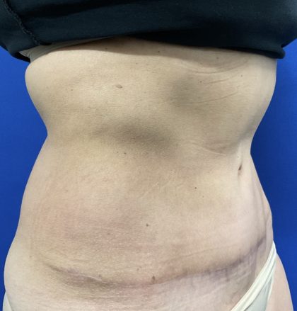Tummy Tuck Before & After Patient #2547