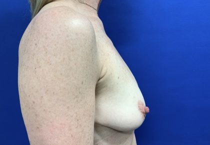Implant Removal with Capsulectomy Before & After Patient #2915
