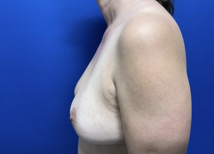 Implant Removal with Capsulectomy Before & After Patient #2916