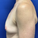 Breast Augmentation Before & After Patient #2632