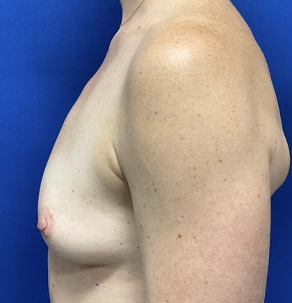 Breast Augmentation Before & After Patient #2632