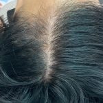 PRP For Hair Restoration Before & After Patient #2902