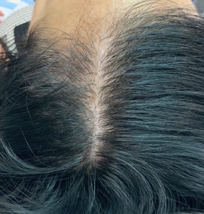 PRP For Hair Restoration Before & After Patient #2902