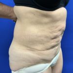 Tummy Tuck Before & After Patient #2549