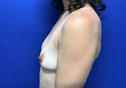 Breast Augmentation Before & After Patient #2668