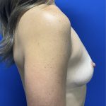 Breast Reconstruction with Direct to Implant with Silicone Implants Before & After Patient #2702