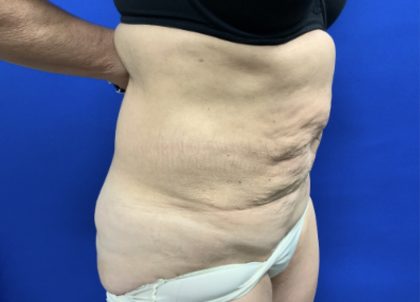 Tummy Tuck Before & After Patient #2549