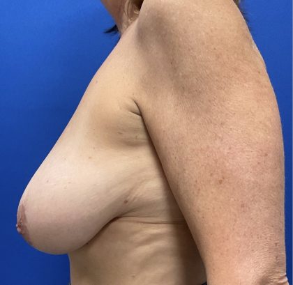 Breast Reduction With Galaflex Before & After Patient #2730