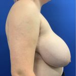 Breast Reduction With Galaflex Before & After Patient #2771