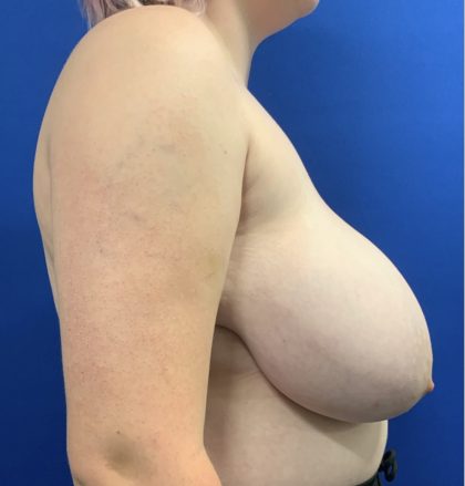 Breast Reduction With Galaflex Before & After Patient #2771