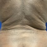 Emsculpt Neo Before & After Patient #2793