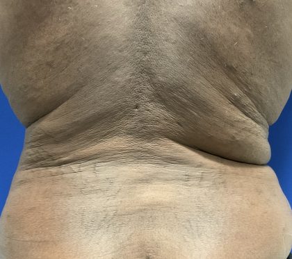 Emsculpt Neo Before & After Patient #2793
