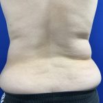 Wellness Program Before & After Patient #2800