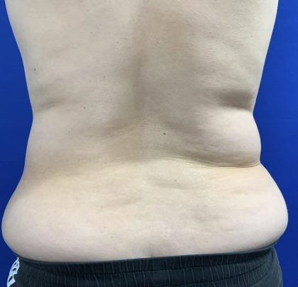 Wellness Program Before & After Patient #2800
