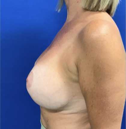 Implant Exchange with Breast Lift Before & After Patient #2828