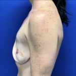 Implant Revision/Removal Before & After Patient #2839