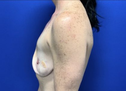 Implant Revision/Removal Before & After Patient #2839
