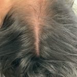 PRP For Hair Restoration Before & After Patient #2902