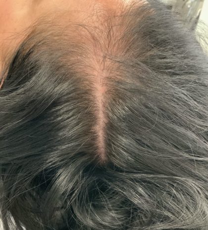 PRP For Hair Restoration Before & After Patient #2902