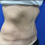 Tummy Tuck Before & After Patient #2549