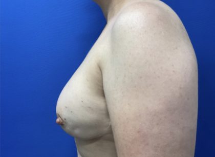 Breast Reconstruction with Direct to Implant with Silicone Implants Before & After Patient #2701