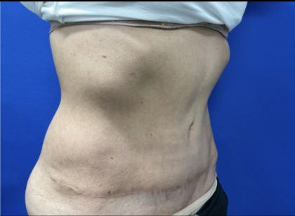 Tummy Tuck Before & After Patient #2549