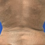 Emsculpt Neo Before & After Patient #2793