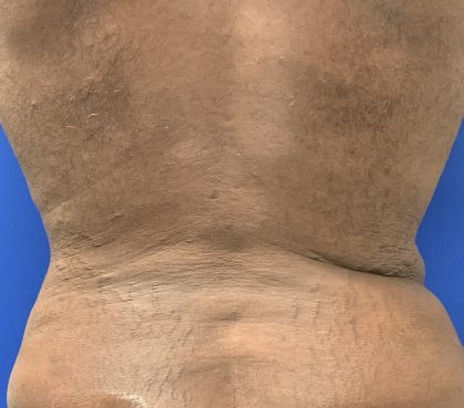 Emsculpt Neo Before & After Patient #2793