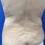 Wellness Program Before & After Patient #2800