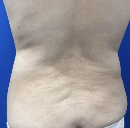 Wellness Program Before & After Patient #2800