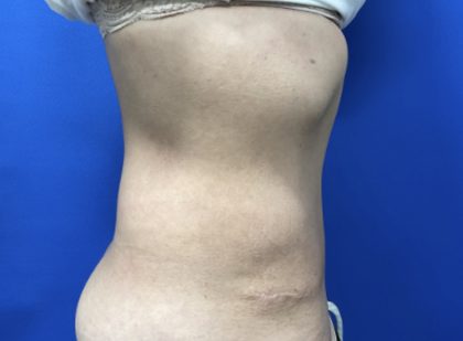 Tummy Tuck Before & After Patient #2549