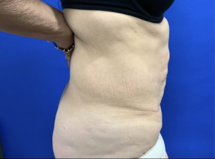 Tummy Tuck Before & After Patient #2549