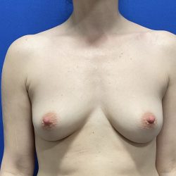 Breast Augmentation Before & After Patient #2669