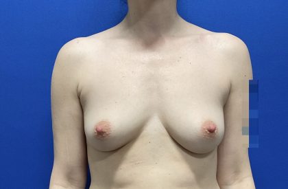 Breast Augmentation Before & After Patient #2669