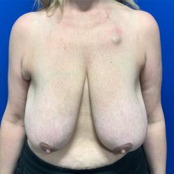 Breast Reduction With Galaflex Before & After Patient #2734