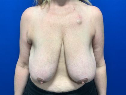 Breast Reduction With Galaflex Before & After Patient #2734
