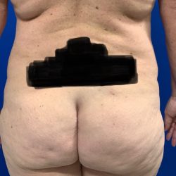 Liposuction Before & After Patient #2977