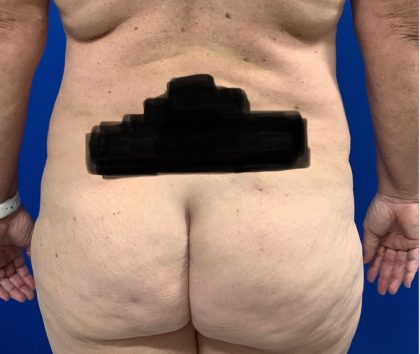 Liposuction Before & After Patient #2977